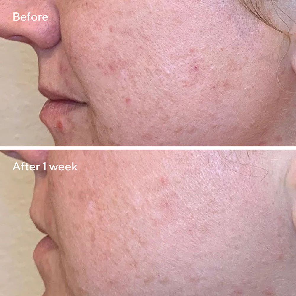 AHA/BHA/Retinoid Daily Clarifying Peel - Image 4